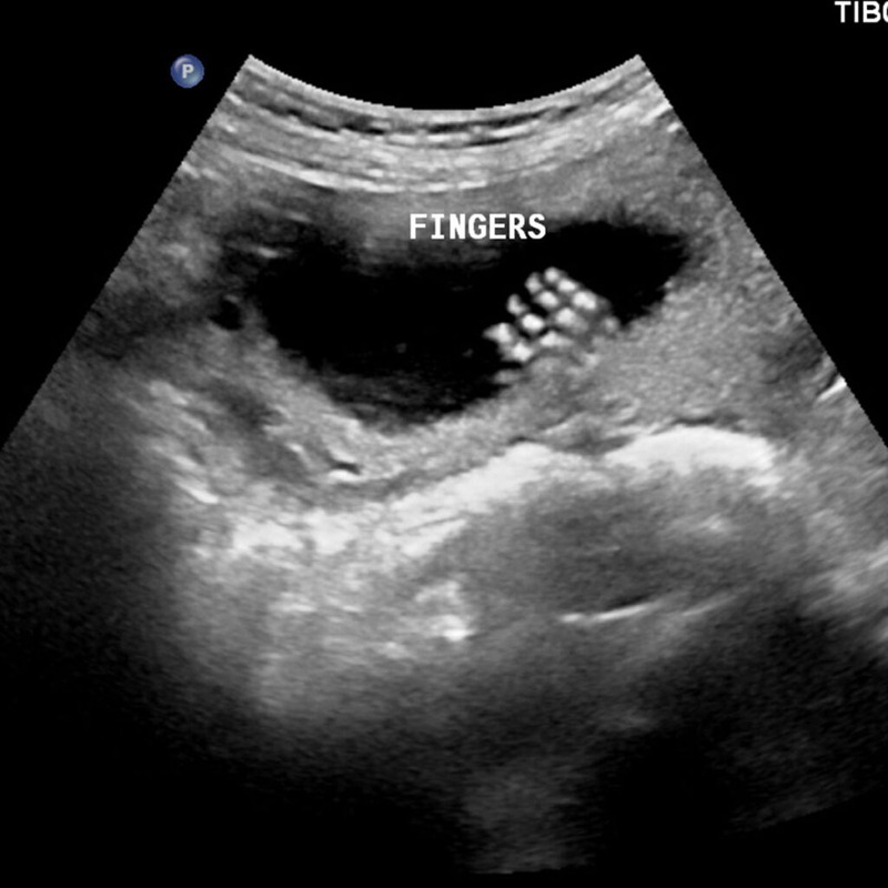 String. Sign Sonogram SONOGRAM BABY